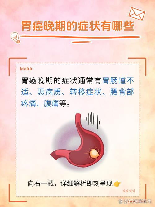 26岁女生患胃癌:疑因幽门螺旋杆菌