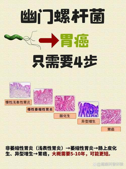 26岁女生患胃癌:疑因幽门螺旋杆菌