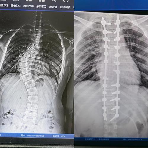 英国女孩“打飞的”来沪治脊柱侧弯