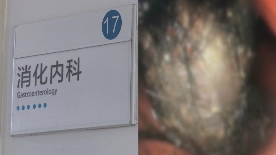 15岁少女吃头发成瘾胃里取出4斤发石