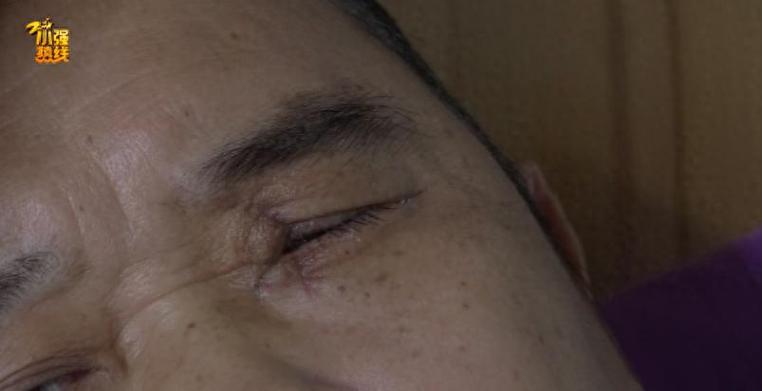 男子眼球被炸破 夏天很多人在用它