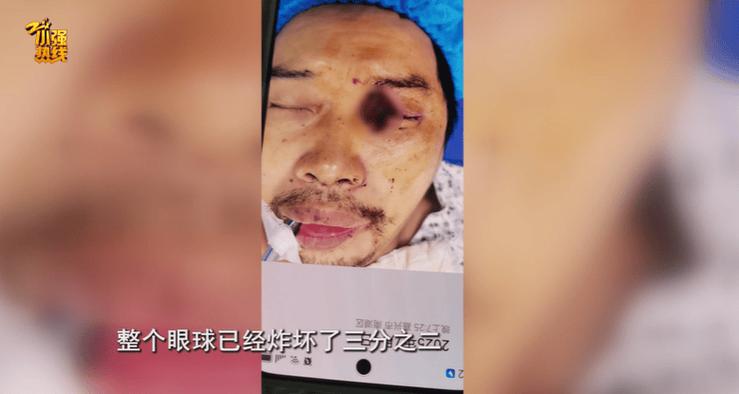 男子眼球被炸破 夏天很多人在用它