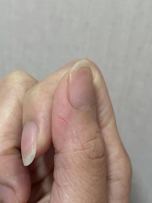 少年被干冰炸伤手指伤口深可见骨