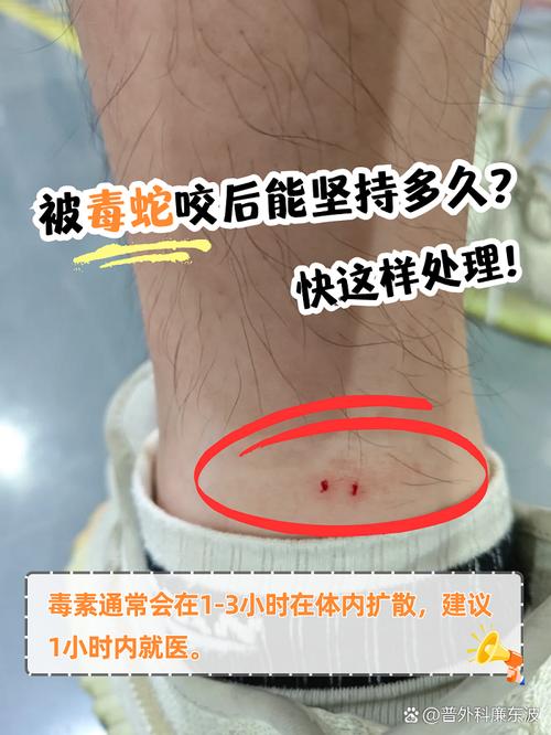 被两种蛇同时咬伤的大叔血清过敏