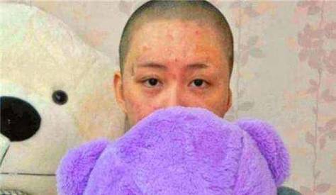女子称逃离家暴时被泼硫酸严重毁容