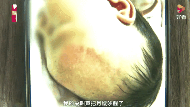 月嫂疏忽致29天婴儿重摔颅内出血