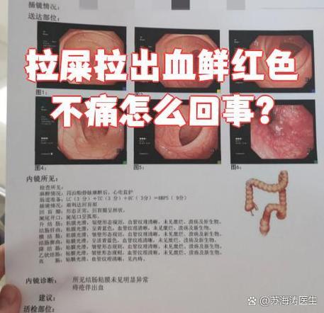 22岁小伙爱吃辛辣致肠道大出血