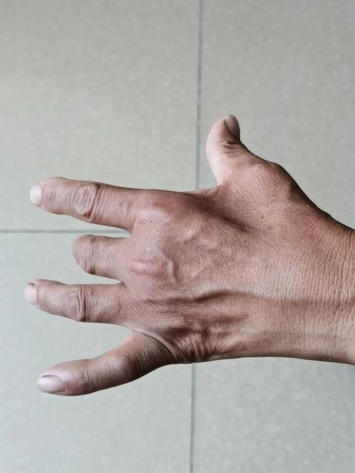 男孩赶14小时作业双手痉挛变鸡爪状