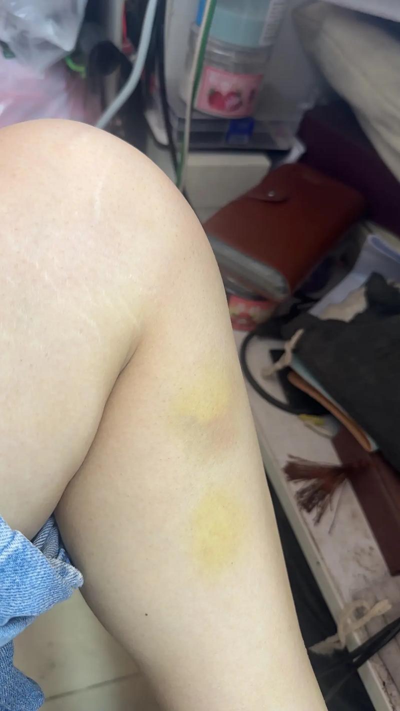 为何女生身体更容易出现淤青