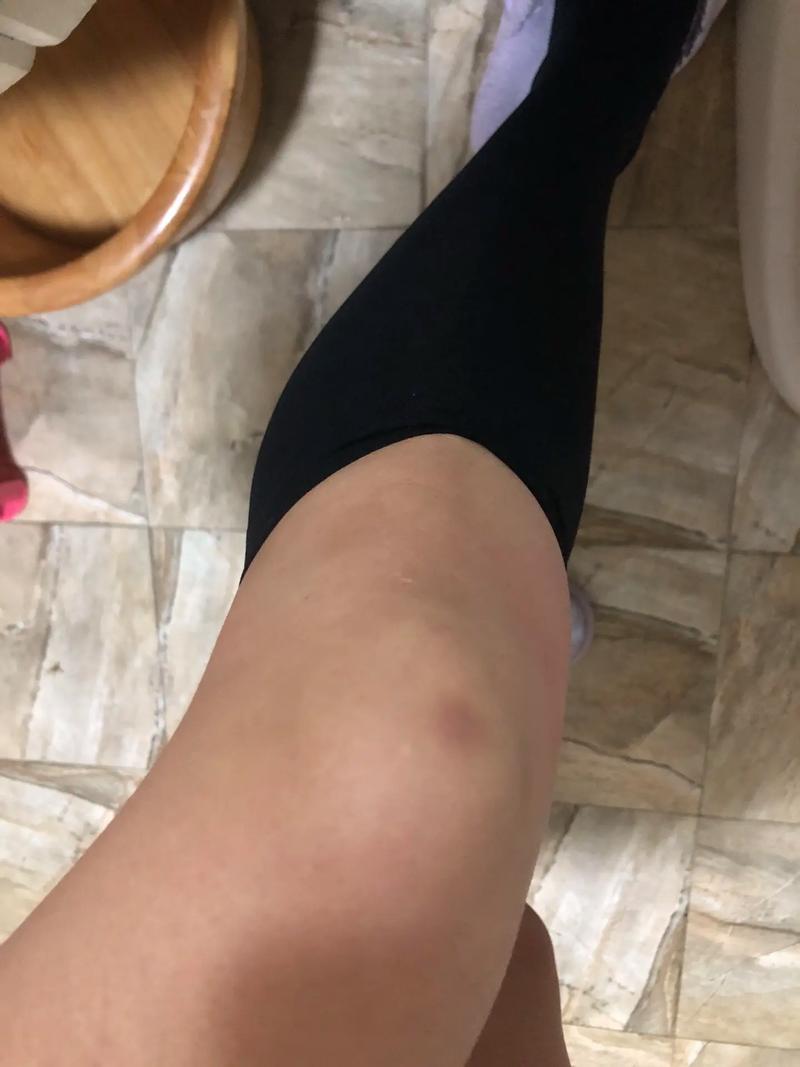 为何女生身体更容易出现淤青