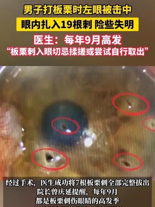 男子打板栗左眼扎入19根刺险失明