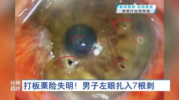 男子打板栗左眼扎入19根刺险失明