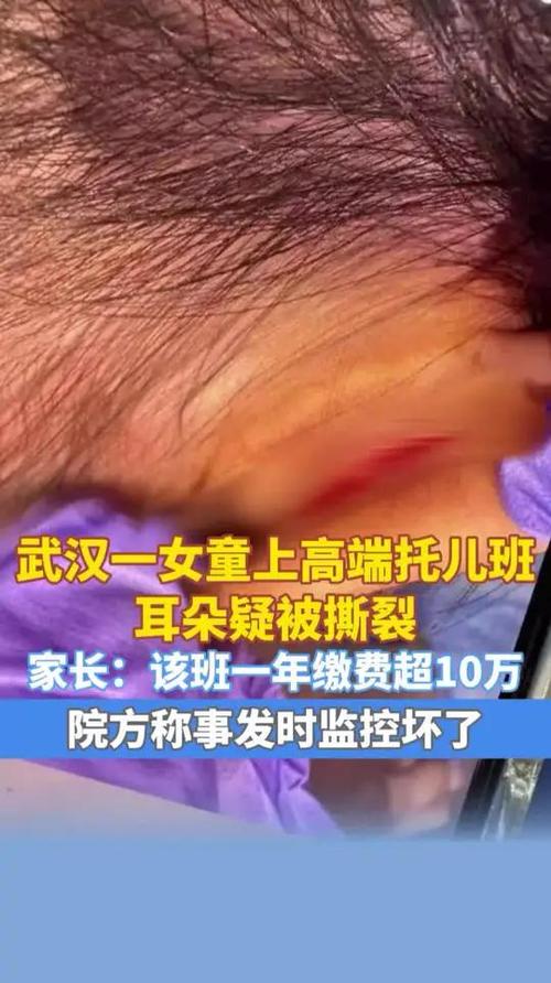 女童上托班耳朵疑被撕裂 家长发声