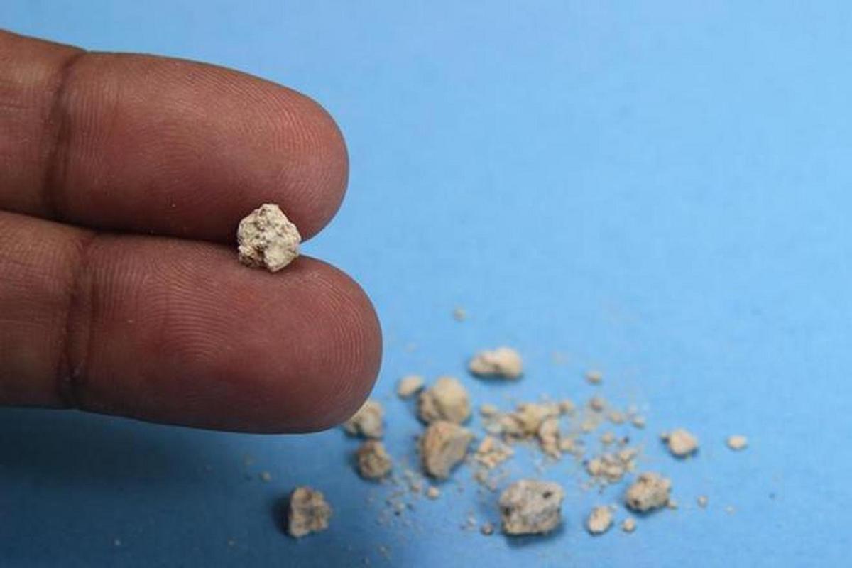男子查出肾结石未重视拖成大麻烦