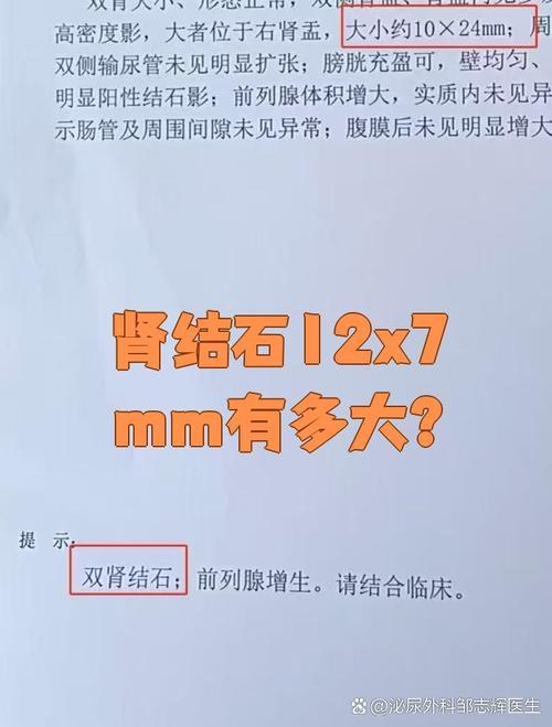 男子查出肾结石未重视拖成大麻烦