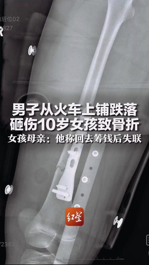 上铺跌落砸伤女孩男子称正筹钱