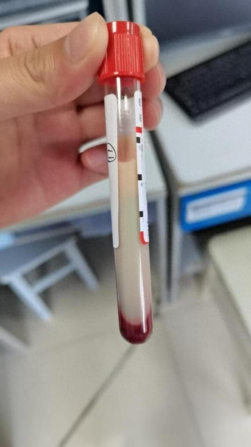 男子体内抽出牛奶血 这样吃饭危害大