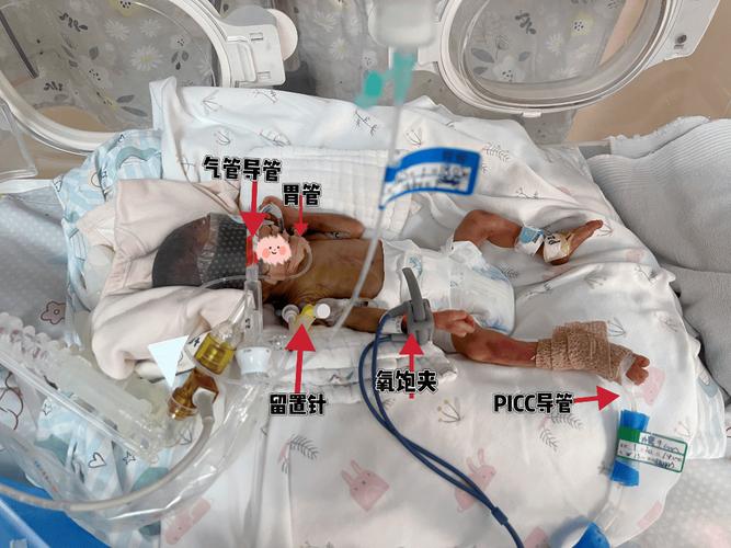 转运坠床新生儿生命体征平稳