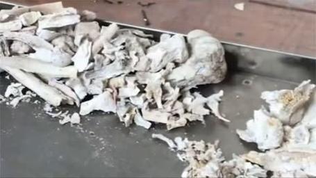 老人火化后骨灰里多出四个钢钉