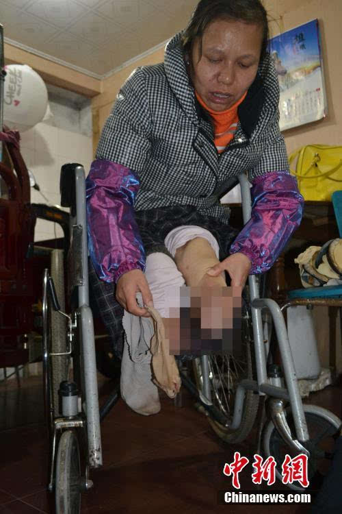 单亲妈妈手脚残疾 用嘴绣鞋垫养家